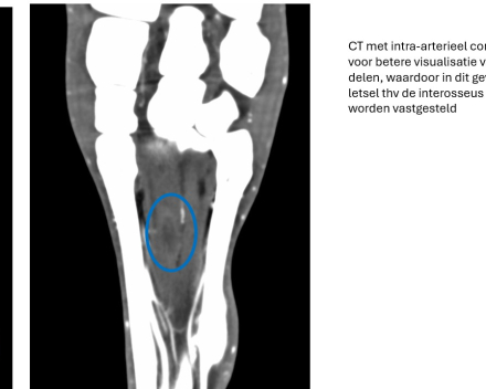 CT met intra-arterieel contrast
